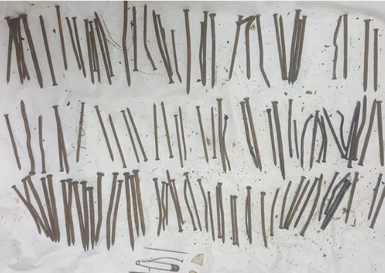 33 yaşındaki Etiyopyalı hastanın midesinden 120 adet çivi çıktı
