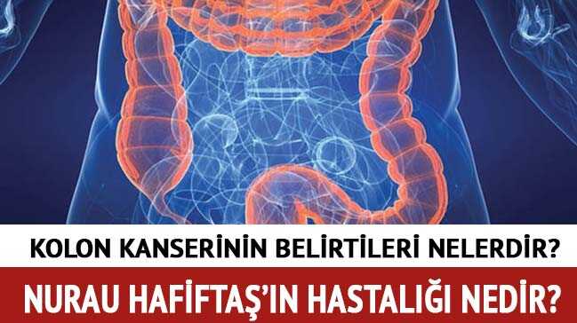Nuray+Hafifta%C5%9F%E2%80%99%C4%B1n+hastal%C4%B1%C4%9F%C4%B1+Kolon+kanseri+nedir+Kolon+kanserinin+belirtileri+neler