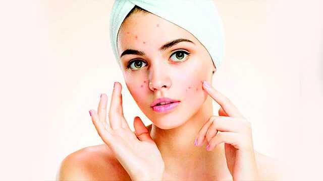 Akne+problemine+son+veren+maske