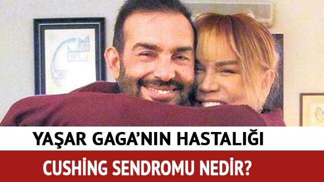 Ya%C5%9Far+Gaga%E2%80%99n%C4%B1n+hastal%C4%B1%C4%9F%C4%B1+cushing+sendromu+belirtileri+neler?+Cushing+sendromu+nedir?